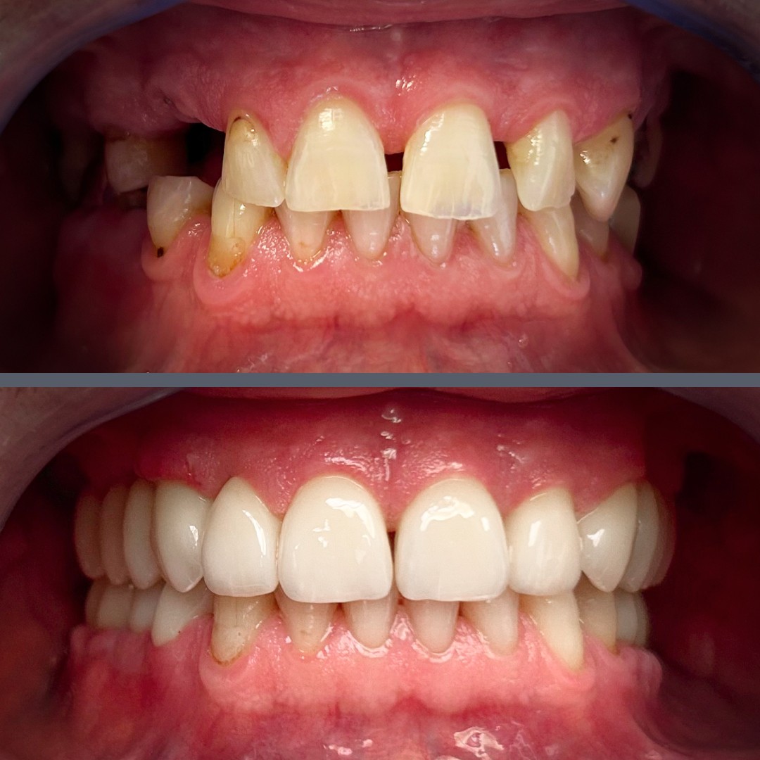 Zirconia Full-Arch Bridge
