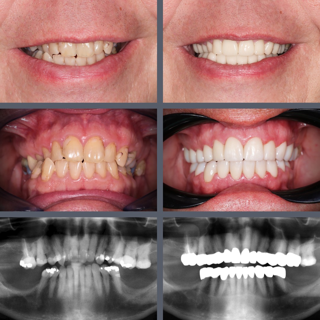 Zirconia Full-Arch Bridges