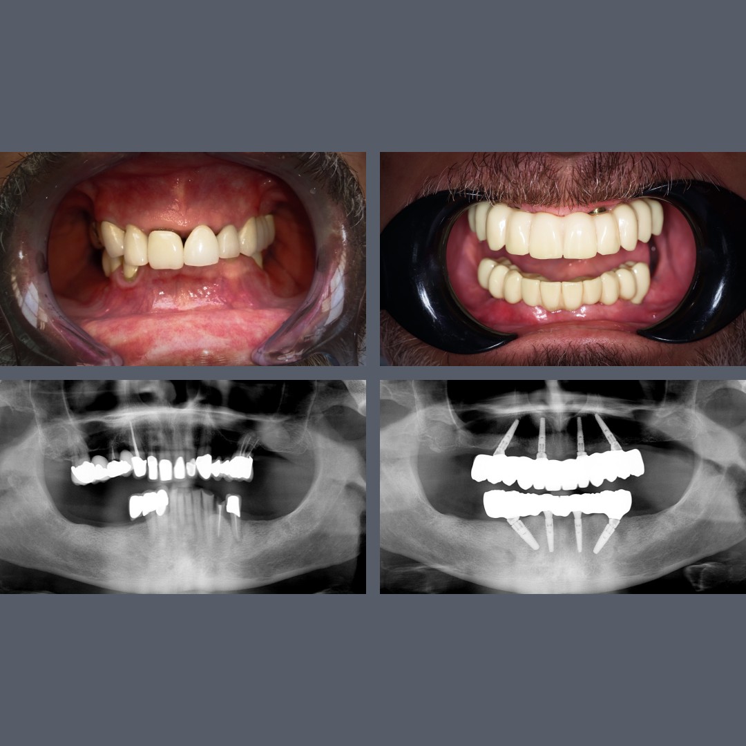 All-on-4® before-after