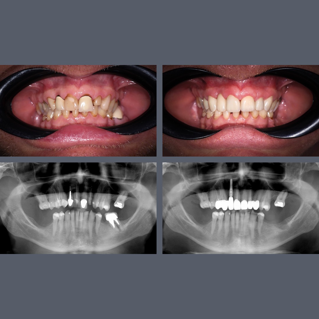 Smile makeover