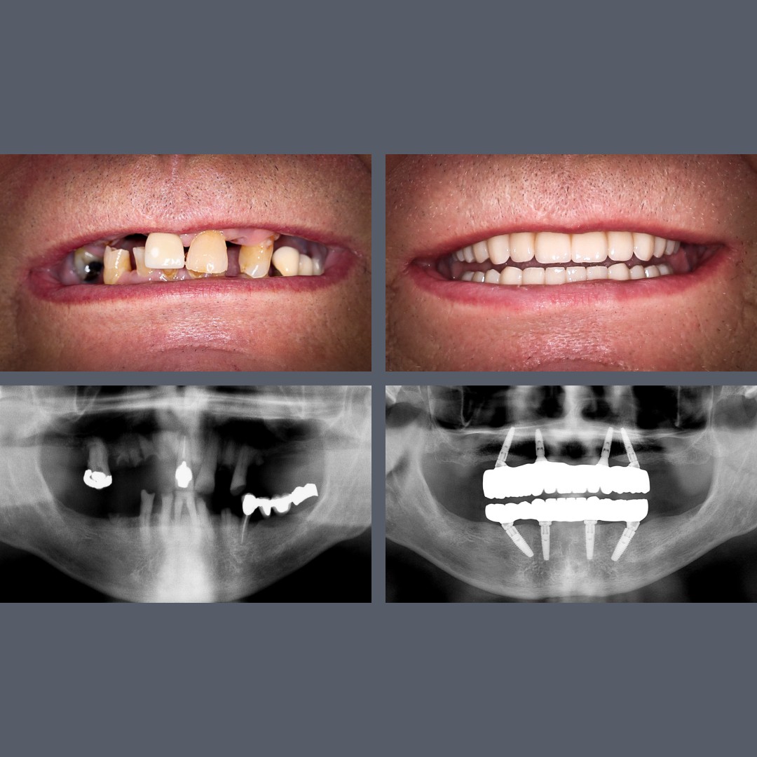 All-on-4® before-after case study