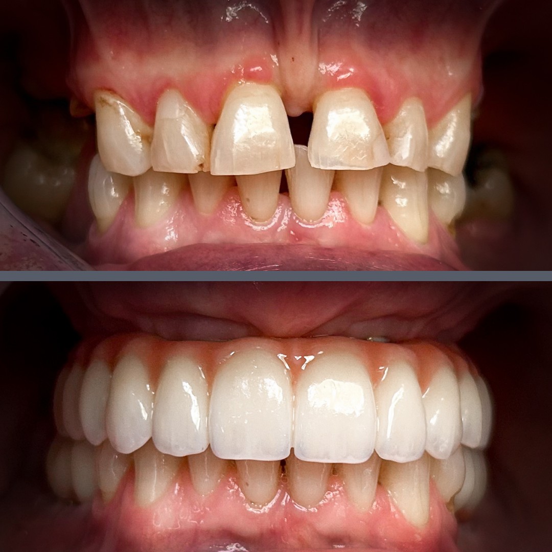 All-on-4 Before-After