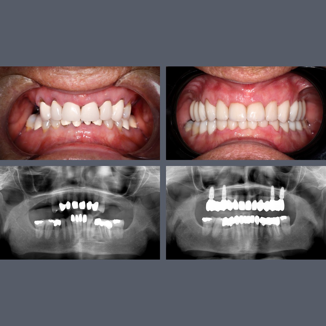 Before-after
