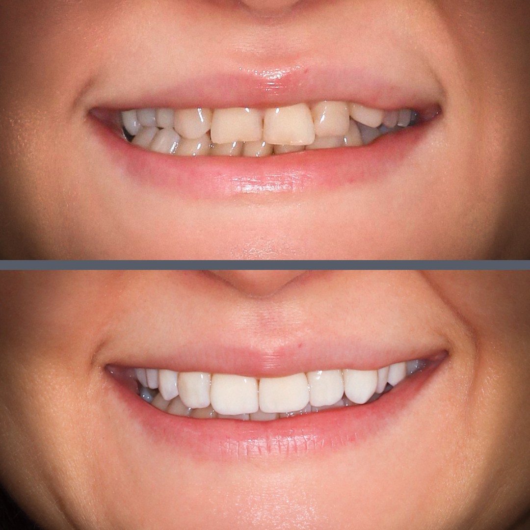 Aesthetic veneers