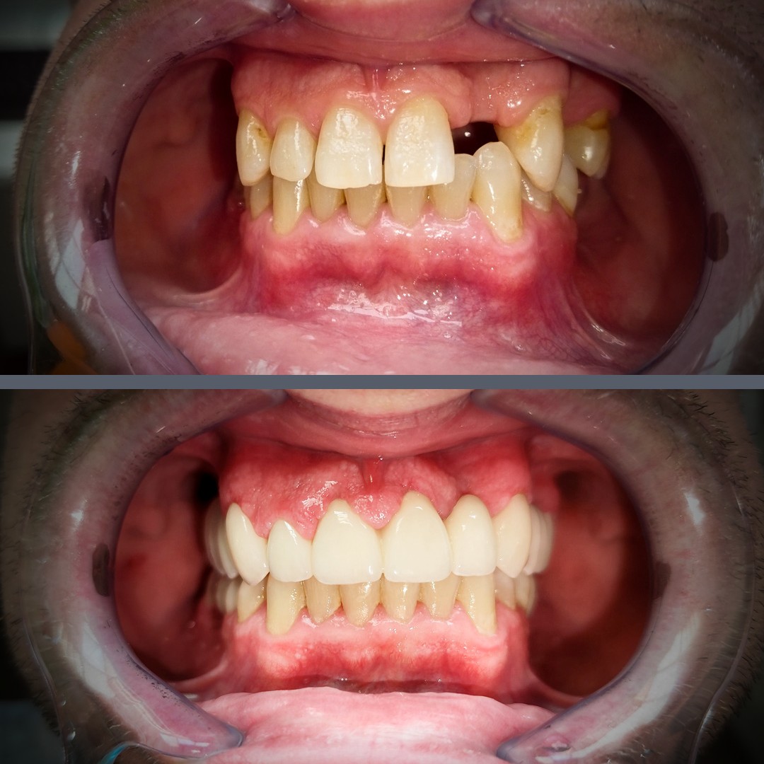 implant-supported tooth replacement