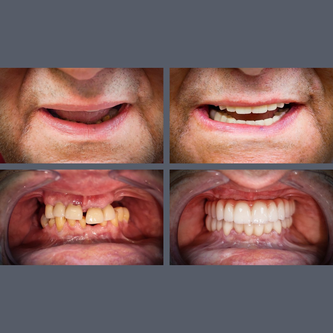 A Functional, Natural Smile with All-on-4®